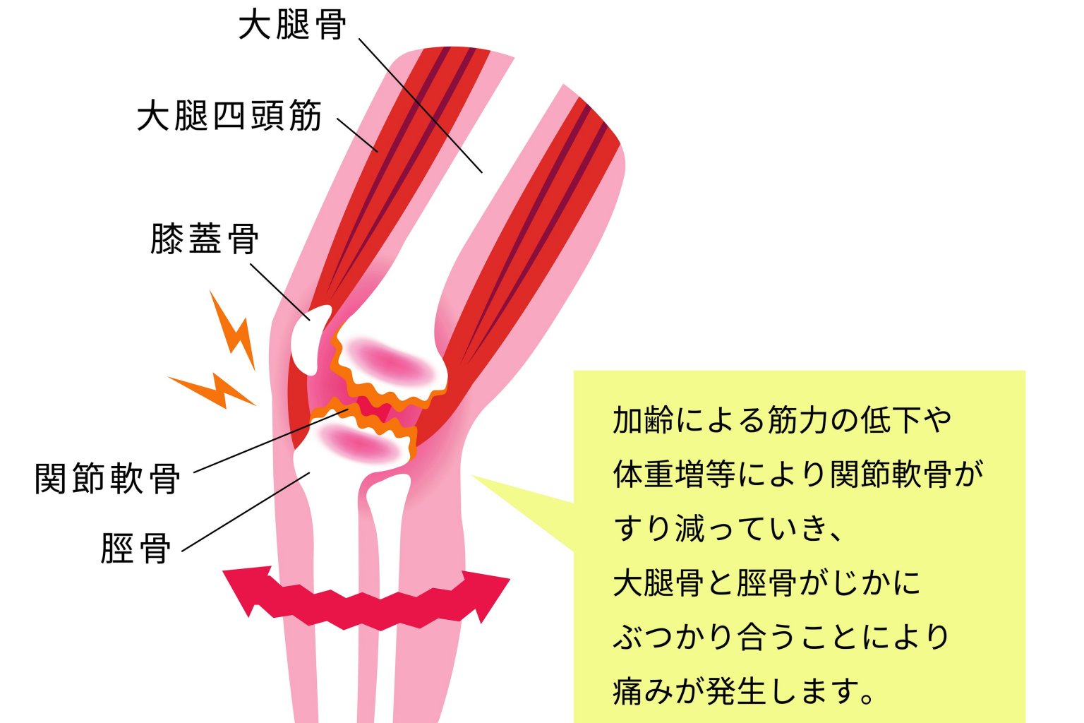 柏市で「変形性膝関節症」などの膝の痛みを改善